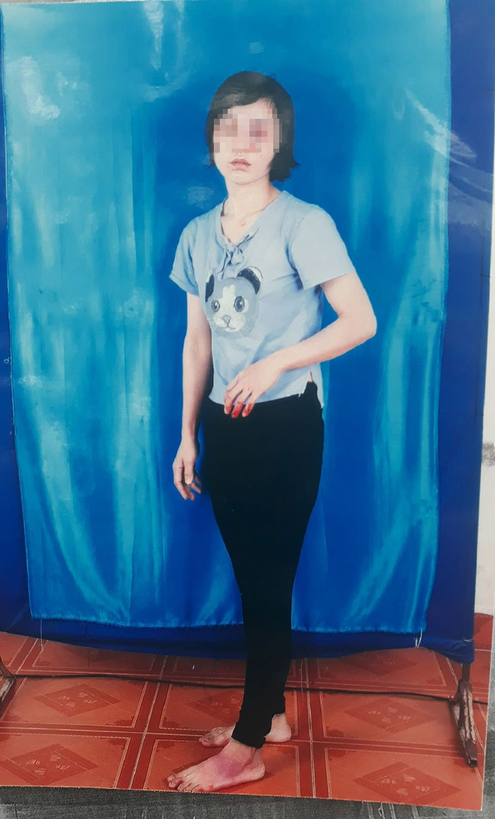 Những vết thương trên người mà chị Hoa tố do bị anh Khoa hành hung.