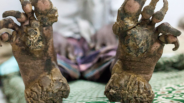 Hội chứng người cây (Epidermodysplasia Verruciformis) được các chuyên gia nghiên cứu là do một virus thuộc họ HPV (Human Papillomavirus) gây ra.