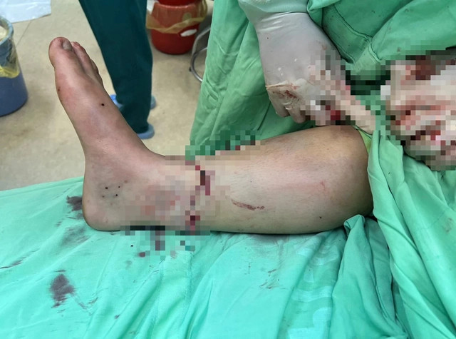 Noi thanh cong doan chan dut roi cho benh nhan tai nan giao thong