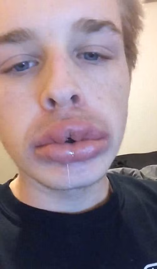 Làm môi căng mọng bằng cốc. Chỉ với một dụng cụ đơn giản là chiếc cốc nhỏ có tên fullip, người dùng chỉ cần chu môi rồi dùng lực hút vào vài phút là có thể sở hữu làn môi căng mọng trong vòng vài giờ.