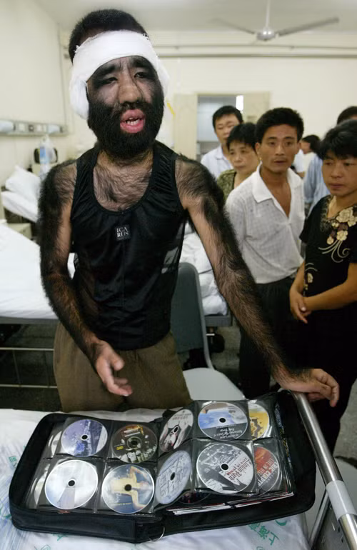 Yu Zhenhuan sinh sống tại Trung Quốc. Anh được biết đến với biệt danh Monkey Man (người khỉ) bởi 96% cơ thể được bao phủ bởi lớp lông đen dày.