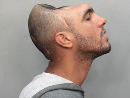 Carlos Rodriguez (Mỹ) được xem là người nửa đầu kì dị nhất. Carlos bị mất nửa hộp sọ trong một tai nạn xe hơi. Được biết, tai nạn xảy ra do lỗi Carlos sử dụng ma túy và rượu trước đó.