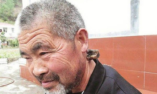 Li Zhibing (62 tuổi) sống tại Thập Yển, Hồ Bắc, Trung Quốc. Li cho biết, trên cổ ông có sự phát triển bất thường từ năm 1980 sau đó mọc thành chiếc sừng và phát triển cùng thời gian. Mong muốn lớn nhất của Li là hiểu được nguyên nhân hình thành chiếc sừng bí ẩn trên cổ. Hiện chiếc sừng dài 15cm song vẫn tiếp tục dài ra khiến cổ ông bị sưng, sốt cao.