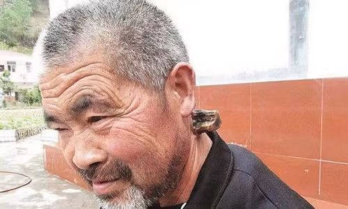 Li Zhibing (62 tuổi) sống tại Thập Yển, Hồ Bắc, Trung Quốc. Li cho biết, trên cổ ông có sự phát triển bất thường từ năm 1980 sau đó mọc thành chiếc sừng và phát triển cùng thời gian. Mong muốn lớn nhất của Li là hiểu được nguyên nhân hình thành chiếc sừng bí ẩn trên cổ. Hiện chiếc sừng dài 15cm song vẫn tiếp tục dài ra khiến cổ ông bị sưng, sốt cao.