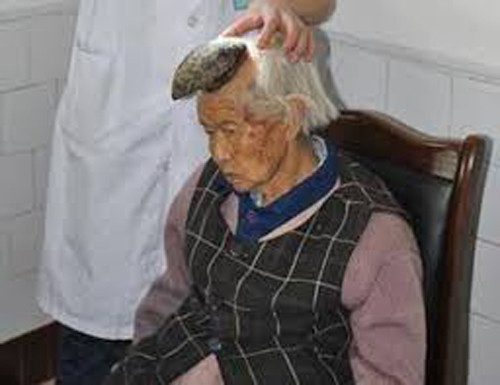 Bà Liang từng có nốt ruồi đen lớn ở vùng hiện đang mọc sừng. Cách đây gần 2 năm, nốt ruồi nứt tách và một chiếc sừng nhỏ bắt đầu mọc lên từ vùng da đó có kích cỡ tương đương một chiếc móng tay nhỏ và dài khoảng 2,5cm. Sau đó, một chiếc sừng mới đã nhanh chóng thay thế chiếc sừng ban đầu và phát triển rất nhanh. Chỉ trong vòng 6 tháng, nó đã dài tới 12,7cm và có đường kính khoảng 5cm.