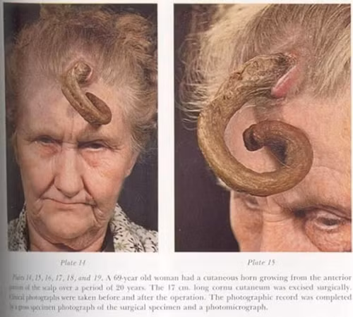 Cụ bà 69 tuổi có chiếc sừng dài 20 cm mọc ngay giữa trán. Cụ đến một phòng khám vào năm 2008 và kể rằng khoảng 20 năm trước, cụ mọc một cái bướu nhỏ. Theo thời gian, u bướu ngày càng dài ra, trở thành chiếc sừng dài và cong. Chiếc sừng kỳ lạ giờ đã được cắt bỏ.