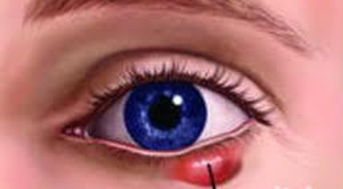 Lẹo thường do viêm tuyến bã (tuyến ziss) hoặc tuyến lệ phụ (tuyến Moll) ở ngay chân lông mi. Ban đầu mi đỏ, rồi sưng lên thành một mụn nhọt và hơi đau. Sau 2-4 ngày cảm giác đau tăng dần, nhức buốt thì hóa mủ, sau đó cả mủ và ngòi vỡ thoát ra cùng với lông mi. Cảm giác đau khó chịu lúc này cũng biến mất. Bệnh có thể tự khỏi nhưng dễ tái phát.