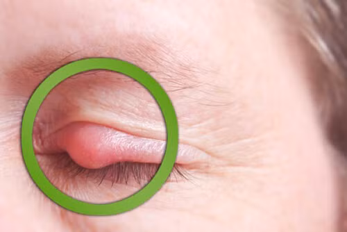 Lẹo mắt là bệnh thường gặp ở mi mắt. Bệnh gây đau nhức bờ mi, kết hợp với tình trạng phù nề làm cho bệnh nhân khó chịu khi nhìn, ảnh hưởng không nhỏ đến sinh hoạt. Lẹo mắt nếu chữa trị không đúng cách có thể để lại sẹo và làm mất thẩm mỹ đôi mắt của bạn.