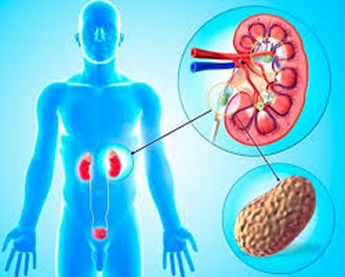 Trường hợp kích thước sỏi thận tương đương hạt đậu hoặc lớn hơn có thể loại bỏ thông qua cách ăn uống. Tuy nhiên, nếu những viên sỏi này có kích thước lớn hơn thì khó có thể đào thải.
