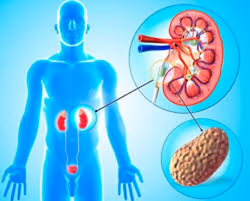 Trường hợp kích thước sỏi thận tương đương hạt đậu hoặc lớn hơn có thể loại bỏ thông qua cách ăn uống. Tuy nhiên, nếu những viên sỏi này có kích thước lớn hơn thì khó có thể đào thải.
