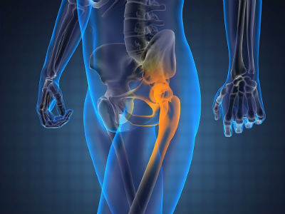 Đau háng được xem là một trong những dấu hiệu sỏi thận ở phụ nữ. Đau háng thường xảy ra khi đi tiểu – thời điểm viên sỏi được đẩy ra từ niệu đạo.