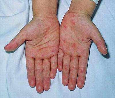 Khi bị sốt xuất huyết thì sẽ xuất hiện những nốt xuất huyết dưới da ở lòng bàn tay, bàn chân.