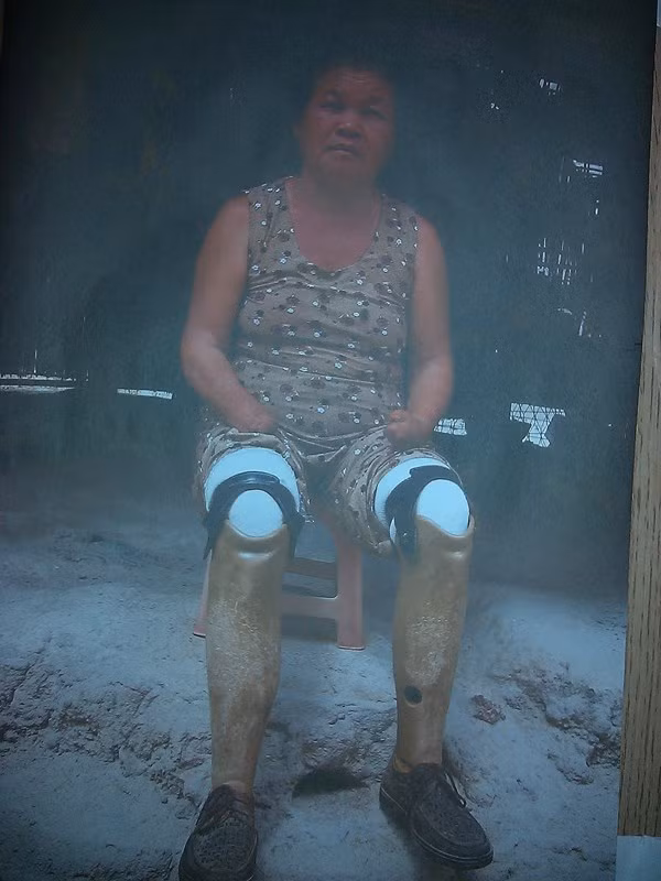 Sau khi phát hiện biến chứng, bà Hu đã được chuyển đến Bệnh viện Chợ Rẫy để điều trị. Tại đây, các bác sĩ chẩn đoán bệnh nhân này bị nhiễm trùng huyết, biến chứng tắc mạch chi và được chỉ định cắt cụt tứ chi.