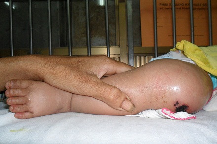 Vùng bụng và chân của bé bị sưng, phù nề.