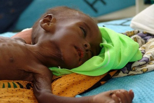 Trẻ thiếu sức mạnh cơ bắp, tay chân gầy gò, ốm yếu.