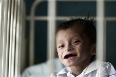 Những dấu hiệu suy dinh dưỡng nặng dưới đây rất nguy hiểm cho trẻ. Thay vì cố gắng tự khắc phục, hãy đưa con đến bác sĩ để được giúp đỡ vì bé đang có nguy cơ rất lớn tới sức khỏe và sự phát triển bình thường.