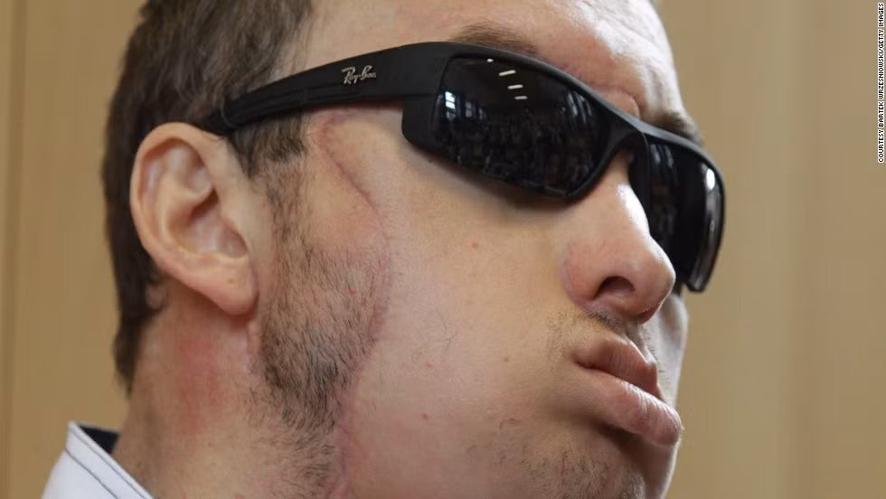 Một người đàn ông Ba Lan tên Grzegorz bị biến dạng khuôn mặt trong một tai nạn lao động khi làm việc tại xưởng. Anh được ghép mặt vào tháng 5/2013. Các bác sĩ Ba Lan nhận định, ca ghép mặt này không chỉ giúp bệnh nhân lấy lại khuôn mặt mà còn cứu mạng sống của anh.