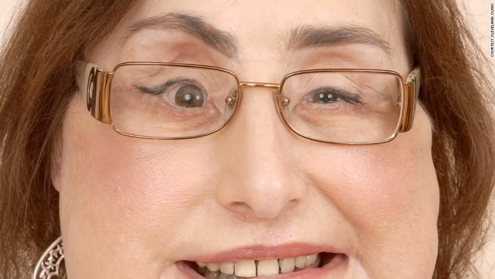 Khuôn mặt của Connie Clup được ghép lại gần như toàn bộ tại bệnh viện Cleveland trong năm 2008. Đây là ca ghép mặt đầu tiên được tiến hành ở Mỹ. 