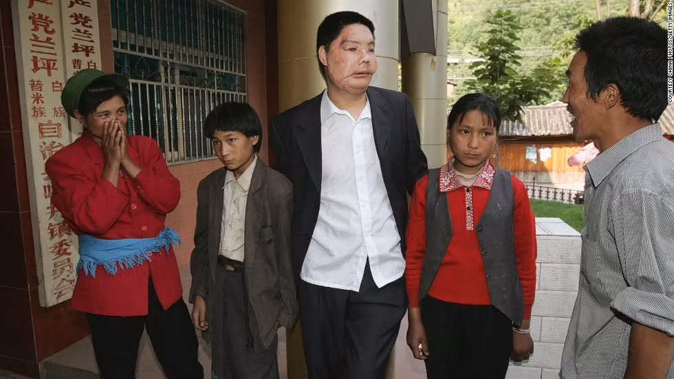 Li Guoxing là bệnh nhân đầu tiên của Trung Quốc được ghép mặt. Bức ảnh ghi lại khoảnh khắc Li Guoxing đứng cạnh các thành viên trong gia đình trong ngôi nhà tại tỉnh Vân Nam 2016. Người đàn ông này qua đời năm 2008. 