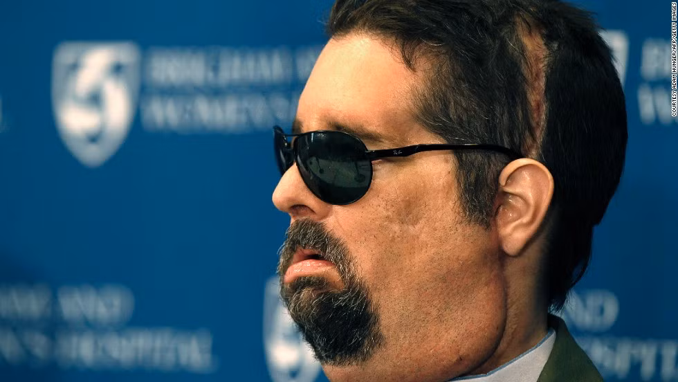 Dallas Wiens từng bị đốt cháy toàn bộ khuôn mặt trong lần giật điện. Khuôn mặt của anh được ghép lại hoàn toàn vào tháng 3/2011.