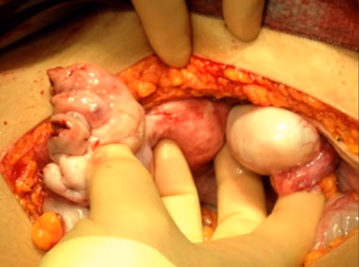 May mắn thay, bác sỹ phẫu thuật có thể loại bỏ khối u ung thư chết người này mà không cần xạ trị. “Khi khối u được lấy ra khỏi cơ thể, nó rất lớn và kỳ lạ. Tôi còn không thể tin được nó đã tồn tại trong cơ thể mình”.