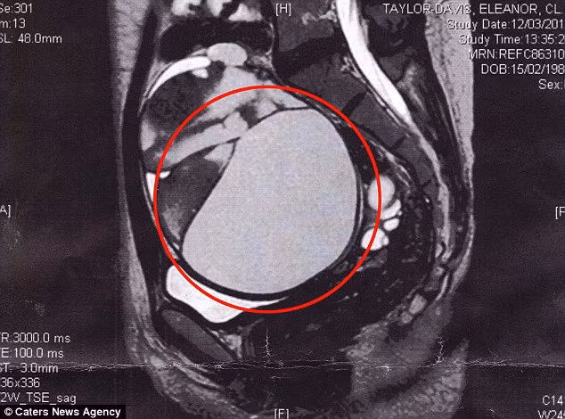 Siêu âm cho thấy khối u có kích cỡ đến 16cm trên buồng trứng. Nó chèn ép cả vào các cơ quan nội tạng khiến cô đi tiểu khó và đầy hơi.