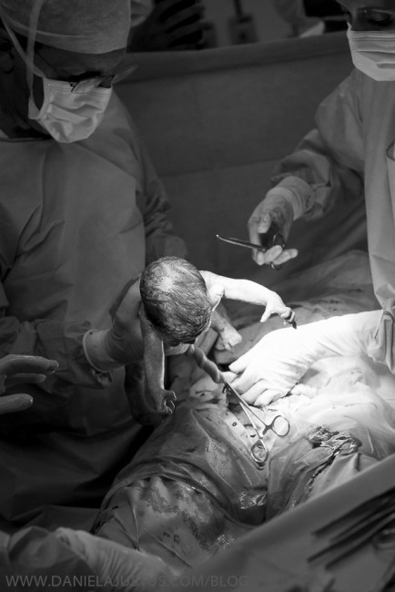 Cận cảnh từ việc các bác sỹ mổ bụng chị Marilia cho đến khi em bé được đưa ra ngoài.