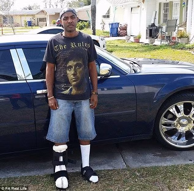 Dù anh may mắn không phải cưa chân nhưng nó vẫn để lại di chứng lâu dài. 3 năm qua sau khi phẫu thuật, anh vẫn không thể đi lại dễ dàng.