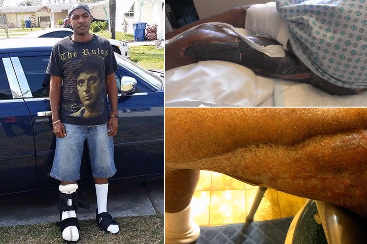 Jawaun Brown, 37 tuổi đến từ bang Ohio, Mỹ được chẩn đoán nhiễm vi khuẩn ăn thịt người, gây hoại tử nghiêm trọng. Vi khuẩn được phát hiện lây nhiễm qua một sợi lông mọc ngược trên chân phải của bệnh nhân.