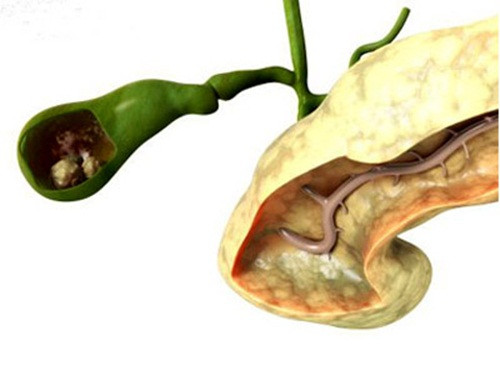 Bệnh viêm tụy mãn tính. Viêm tụy mạn tính là tình trạng tuyến tụy bị viêm trong thời gian dài. Tình trạng này có liên quan với việc tăng nguy cơ ung thư tuyến tụy, tuy nhiên nguy cơ này không cao.