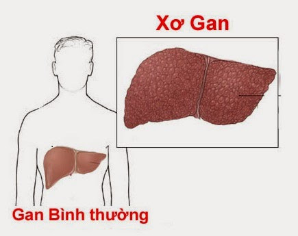 Bệnh xơ gan. Xơ gan do viêm gan hay sử dụng rượu thì tăng nguy cơ ung thư tuyến tụy. Những bệnh nhân bị xơ gan cũng có nguy cơ cao mắc bệnh ung thư tuyến tụy do gan hoạt động kém làm tuyến tụy phải làm việc nhiều hơn và nhanh suy yếu hơn.