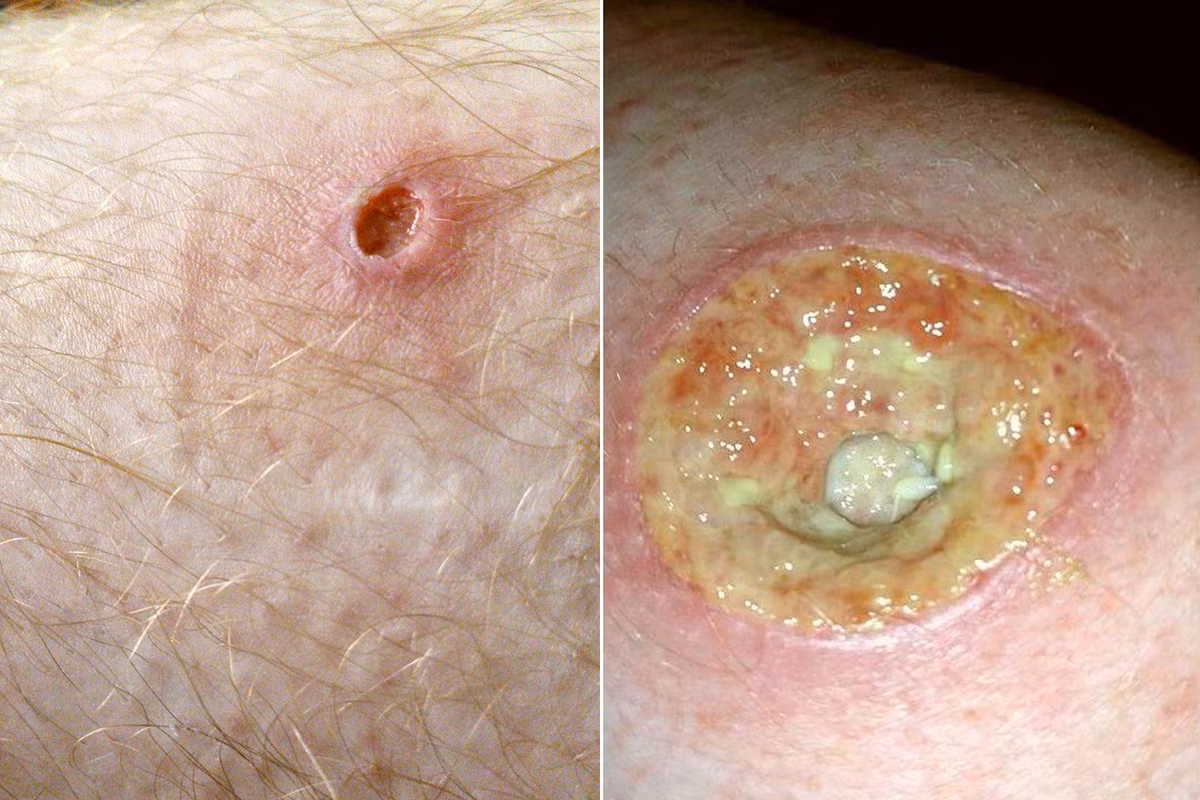 Theo bác sỹ, căn bệnh này thường xảy đến với những người ở tuổi thanh niên và trung niên. Tuy nhiên, nó cũng ảnh hưởng đến những người có vấn đề về viêm ruột như bệnh Crohn hoặc viêm đại tràng, viêm khớp, ung thư máu hoặc viêm gan.