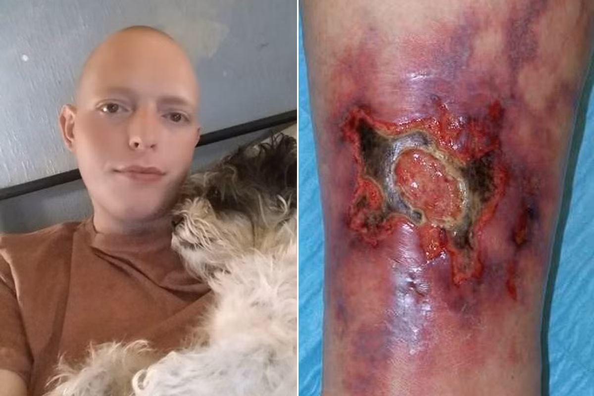 Căn bệnh ngoài da này khiến anh Jamie phải chịu đựng đau đớn mỗi ngày. Chàng trai trẻ chỉ có thể đi bộ và thay băng đẫm máu vào mỗi buổi sáng. Có ngày anh còn phải thay đến 2-3 lần băng gạc.