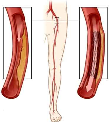 Tắc động mạch. Trong cơ thể, các động mạch có nhiệm vụ đưa máu chứa chất dinh dưỡng đến nuôi các cơ. Động mạch ở chân bị tắc nghẽn sẽ làm giảm lượng máu xuống chân khiến chân bị thiếu chất dinh dưỡng và ôxy, nếu nặng dễ dẫn đến hoại tử chân.