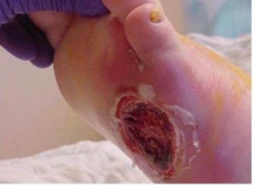 Bệnh thường trải qua 4 giai đoạn chính. Giai đoạn 1 không có triệu chứng. Giai đoạn 2 là đau cách hồi, tức là đi một đoạn phải dừng lại do cảm giác đau ở chân. Ở giai đoạn 3, cảm giác đau xuất hiện ngay khi nghỉ, đặc biệt là đau về đêm. Giai đoạn cuối cùng là tình trạng hoại tử hoặc lở loét ở các ngón chân và bàn chân.