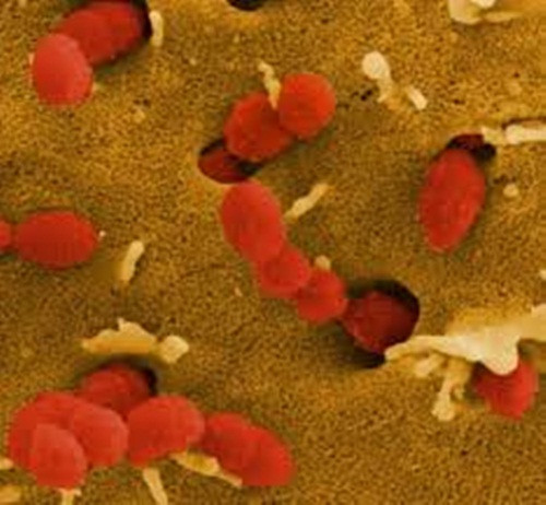 Nhiễm khuẩn liên cầu lợn. Căn bệnh thường gặp ở những người nuôi và giết mổ lợn, ăn thịt tái, tiết canh. Bệnh viêm cầu lợn có thể dẫn tới nhiễm trùng huyết, viêm màng não mủ và hoại tử da.