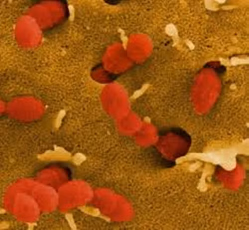 Nhiễm khuẩn liên cầu lợn. Căn bệnh thường gặp ở những người nuôi và giết mổ lợn, ăn thịt tái, tiết canh. Bệnh viêm cầu lợn có thể dẫn tới nhiễm trùng huyết, viêm màng não mủ và hoại tử da.