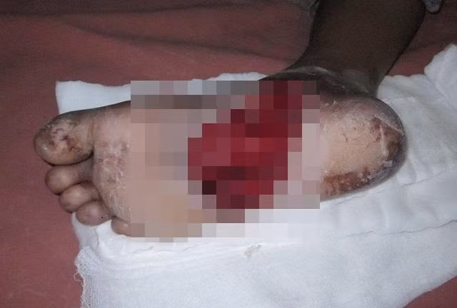 Viêm chân hoại tử. Bệnh này do chủng vi khuẩn Aeromonas hydrophila xâm nhập vào vết thương hở như vết bầm hay đứt tay và phá hủy các mô tế bào xung quanh. Bệnh nếu nặng có thể gây tử vong chỉ trong 18 giờ. 25% số người mắc bệnh đều tử vong.