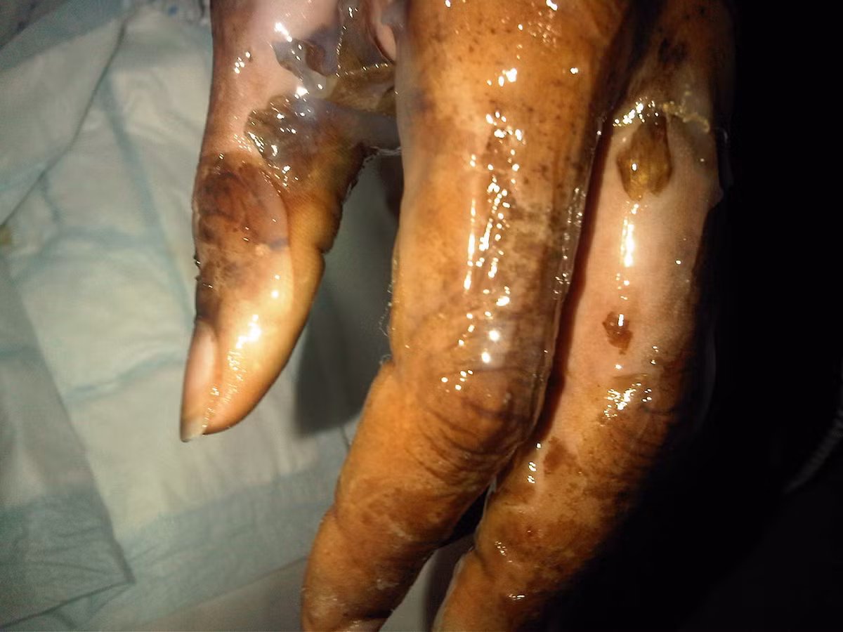 Họ còn thông báo với gia đình, chuẩn bị cho trường hợp xấu nhất có thể xảy ra. Mẹ cô gái cho hay, nhìn con bà như nhân vật trong một bộ phim kinh dị vậy. “Tôi thấy thần chết đang gõ cửa con gái, tất cả chỉ vì một lọ thuốc nhỏ mắt”.