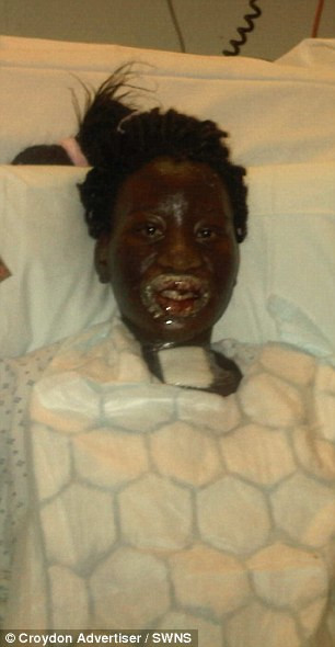 Bác sỹ xác định, cô gái mắc một loại dị ứng hiếm và rất khó để kháng lại. Nếu không được điều trị thì tình trạng này có thể dẫn đến cái chết hoặc mù lòa hay tổn thương phổi.