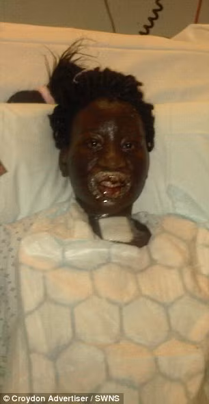 Bác sỹ xác định, cô gái mắc một loại dị ứng hiếm và rất khó để kháng lại. Nếu không được điều trị thì tình trạng này có thể dẫn đến cái chết hoặc mù lòa hay tổn thương phổi.