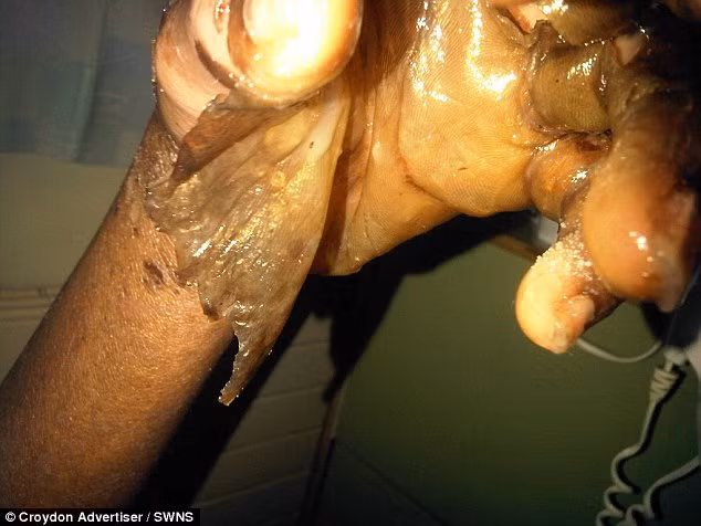 Miss Teen suýt chết vì dị ứng thuốc nhỏ mắt - Hình 2 Miss Teen suyt chet vi di ung thuoc nho mat-Hinh-2