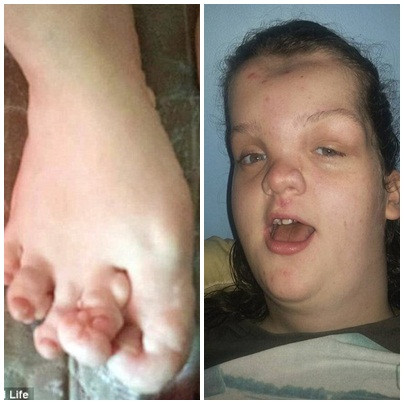 Hội chứng Proteus này được đặc trưng bởi sự phát triển quá mức của da và xương. Ngoài ra còn có sự tăng trưởng bất thường của các mô dẫn đến sự phát triển không cân xứng của cơ thể. Kết quả là hình thành nên các khối u trong cơ thể. Chỉ khoảng 1/1.000.000 người sinh sống mắc hội chứng này.