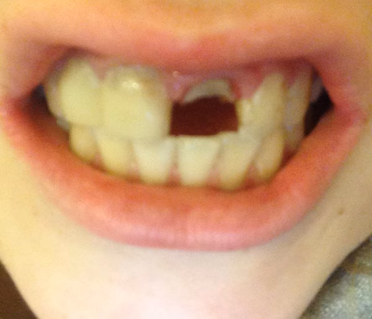 Được biết Linzi bị bệnh tiểu đường loại 1 và bác sỹ xác định đây là nguyên nhân khiến răng của cô suy yếu. Thế nhưng, cô gái cho hay, mình có kiêng cữ đồ ngọt và đi thăm khám định kỳ đầy đủ.