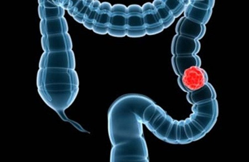 Nguyên nhân bạn bị đầy bụng là do các khối u gây tắc đường ruột và ngăn khí gas cũng như phân đi qua. Những triệu chứng khác của ung thư đại tràng bao gồm phân dính máu, hình dạng phân thay đổi và cảm giác buồn tiểu gấp.