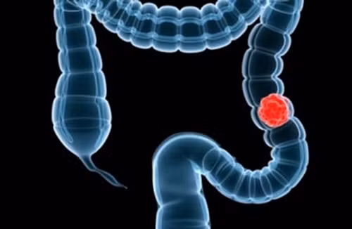 Nguyên nhân bạn bị đầy bụng là do các khối u gây tắc đường ruột và ngăn khí gas cũng như phân đi qua. Những triệu chứng khác của ung thư đại tràng bao gồm phân dính máu, hình dạng phân thay đổi và cảm giác buồn tiểu gấp.