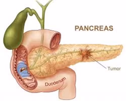 Khi có khối u ung thư tuyến tụy, axit sẽ tràn ra và ăn mòn tuyến tụy, gây ra đau bụng và đau lưng. Hàng năm, có hàng triệu người bị đau vùng này và không ai nghĩ nó là dấu hiệu ung thư. Tuy nhiên, nếu đau dai dẳng không khỏi, kèm theo vàng da hoặc phân nhạt màu, đừng loại trừ khả năng.