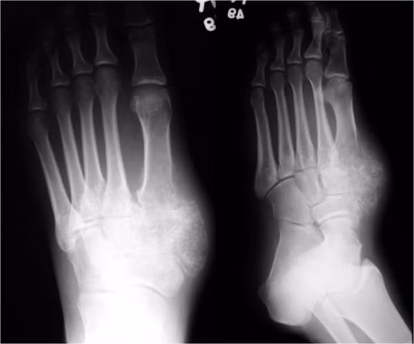 Ung thư sụn trung mô. Loại ung thư này cực hiếm và chỉ có khoảng 1000 trường hợp mắc bệnh từ năm 1959. Mặc dù hiếm, ung thư sụn trung mô rất nguy hiểm và tiến triển nhanh. Nó tấn công hạch bạch huyết và lây lan ra các cơ quan khác nếu không phát hiện sớm.