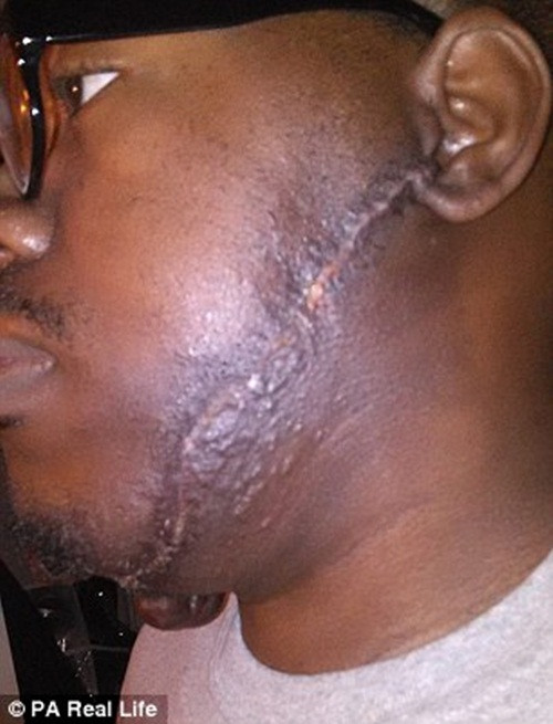 Một nửa nấm thịt bên mặt còn lại sẽ được diễn ra vào tháng tới. Anh hy vọng lần này sẽ thành công để anh làm đám cưới với tình yêu của đời mình.