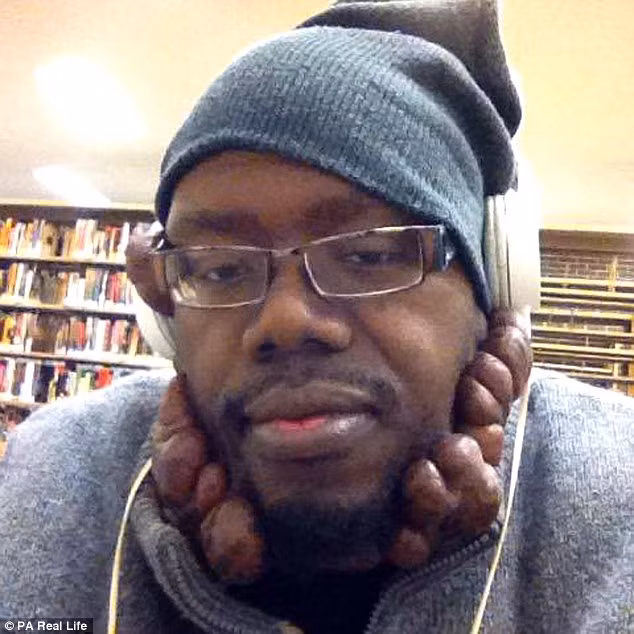 Anh Keenan Patton, 32 tuổi được mọi người gọi là “người mặt nấm” vì các sẹo lồi phát triển rất nhanh trên khuôn mặt. Những sẹo lồi này mọc lên từ khi anh bị thủy đậu vào năm 11 tuổi.